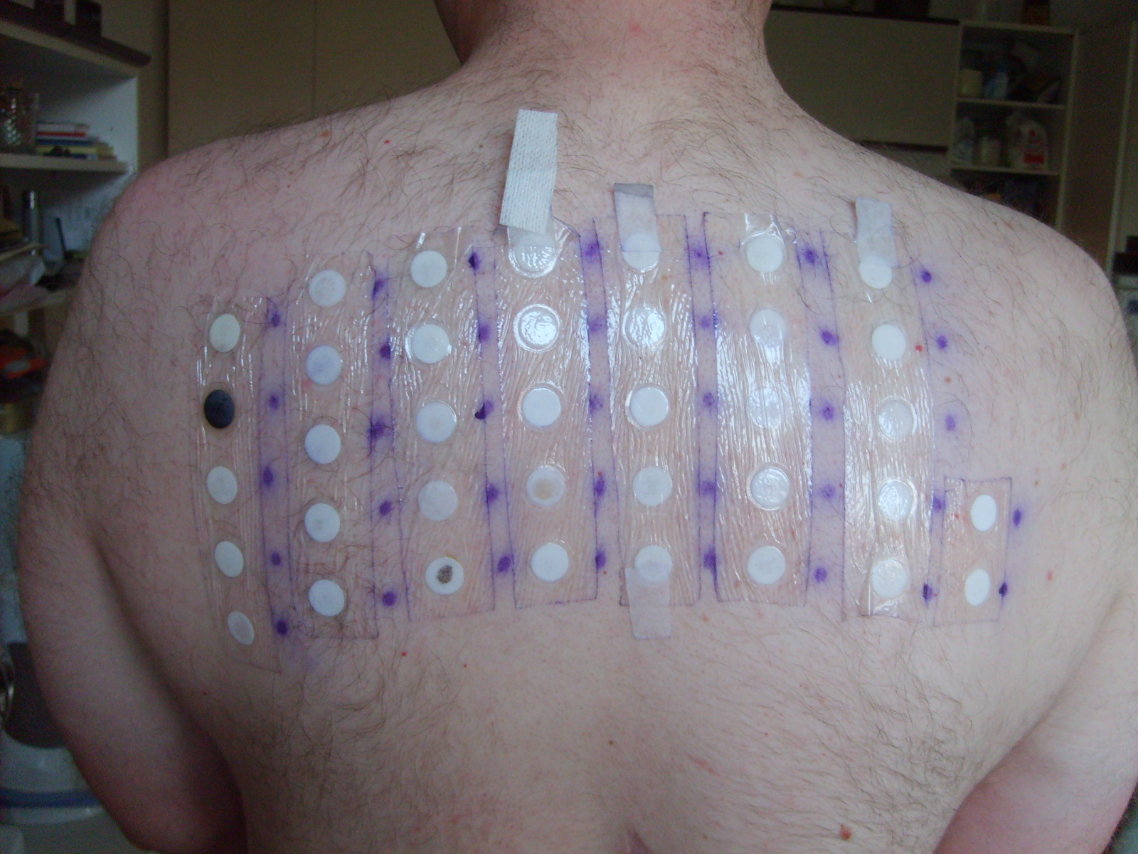 A clinical photograph of standardised patch-test allergens applied to marked sites on the upper back before delayed readings are assessed.