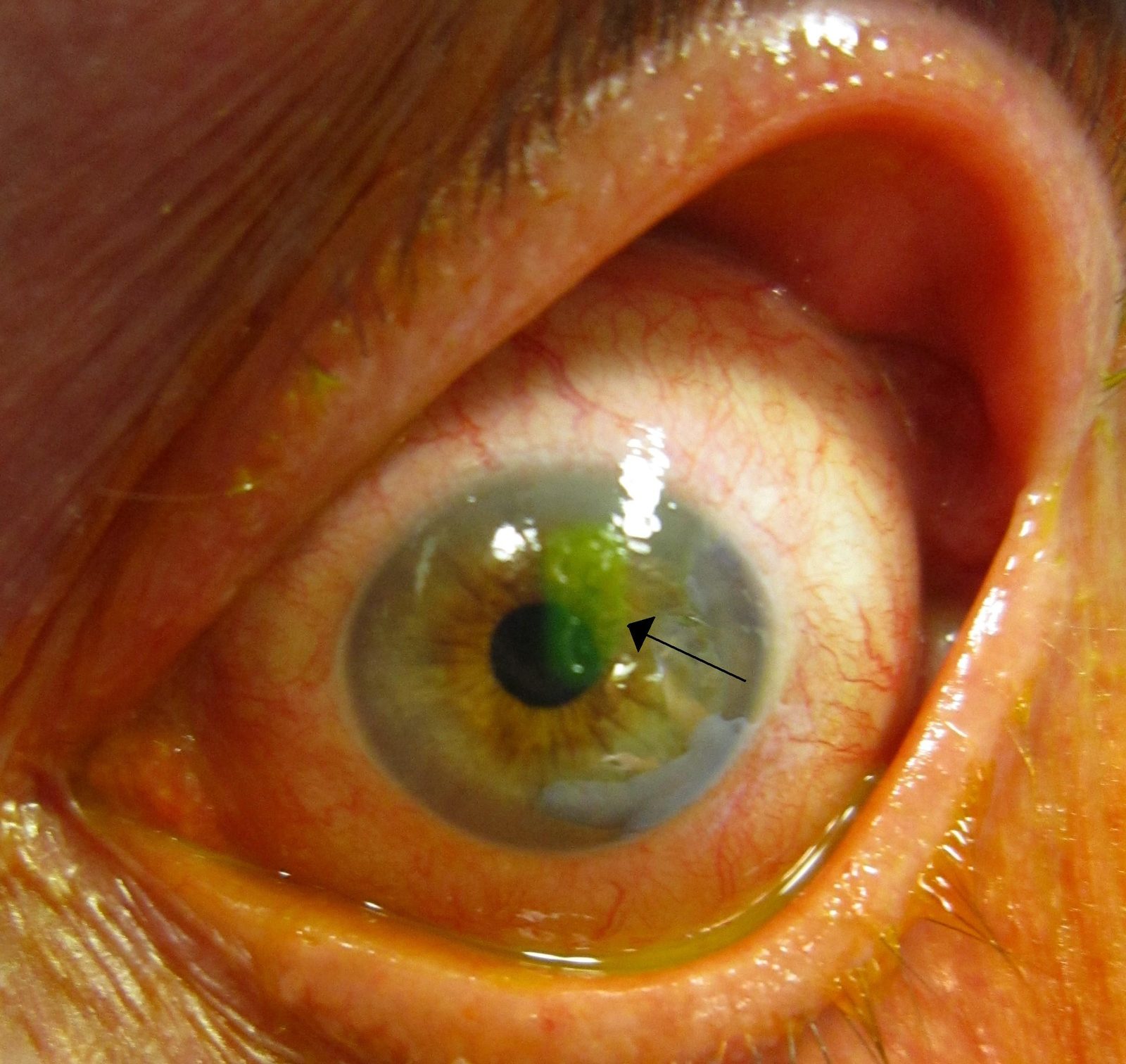 Clinical photograph after fluorescein showing a bright green corneal epithelial defect. Label it as an illustrative clinical image and explain that fluorescein findings must be interpreted with mechanism, visual acuity and slit-lamp examination.