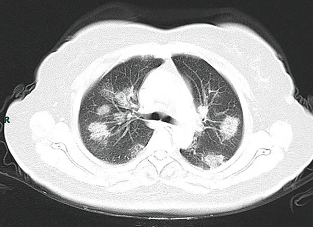 Axial chest CT showing multiple bilateral, predominantly peripheral rounded ground-glass and consolidative opacities in COVID-19 pneumonia.