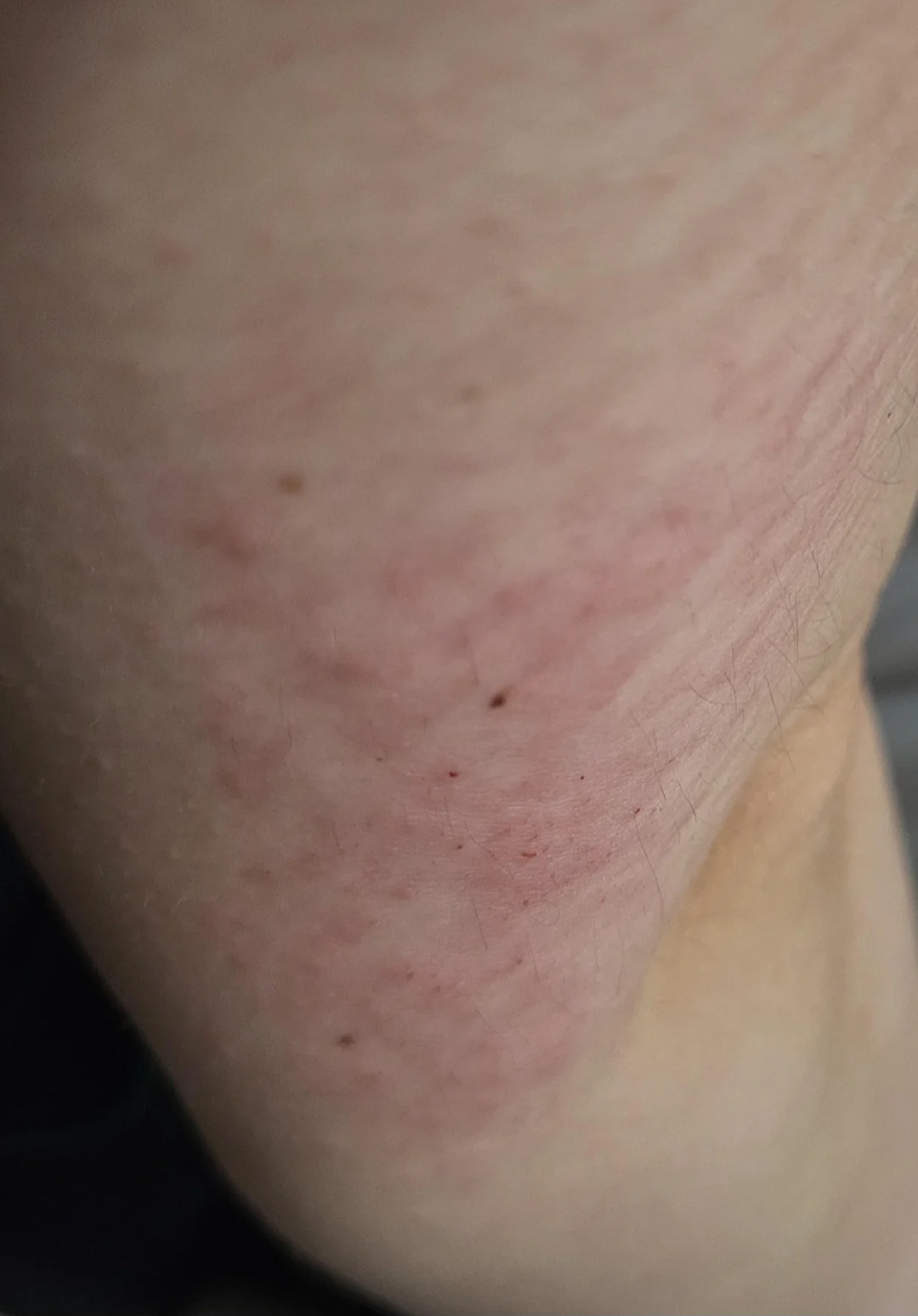 Clinical photograph showing a localised erythematous rash after exposure to a product containing casein, illustrating a possible cutaneous manifestation of cow's milk protein allergy; retain source attribution while image-quality remediation remains separate.