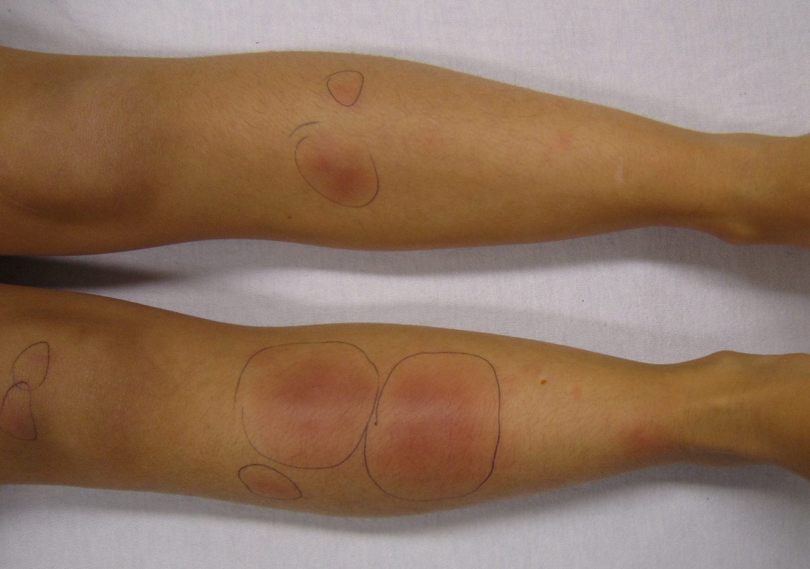 Tender erythematous shin nodules, an extraintestinal manifestation that usually tracks with bowel disease activity.