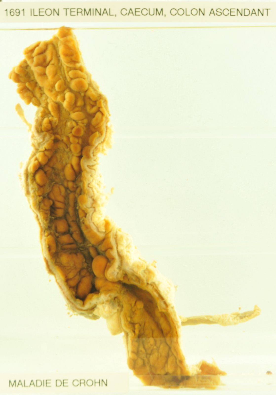 Opened resection specimen of terminal ileum, caecum and ascending colon showing thickened, cobblestoned mucosa, with diseased segments separated by normal bowel (skip lesions).