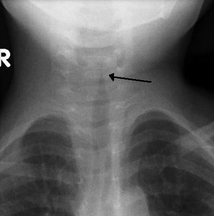 Anteroposterior neck radiograph showing smooth, symmetric subglottic tracheal tapering, marked by the arrow, producing the steeple sign of croup.