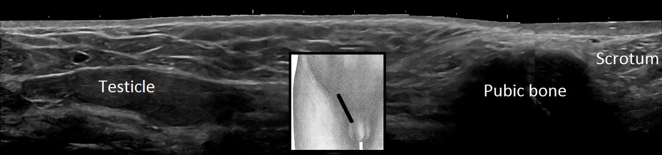 Annotated longitudinal ultrasound showing an undescended testis in the inguinal region between the pubic bone and empty scrotum; retain source attribution while image-quality remediation remains separate.