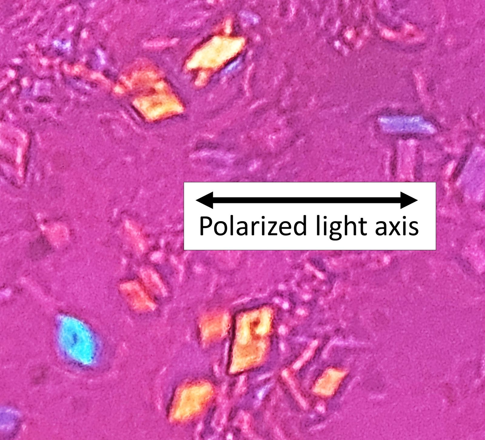Polarised-light microscopy showing rhomboid calcium pyrophosphate crystals, which are weakly positively birefringent; compare with the needle-shaped, negatively birefringent urate crystals of gout.