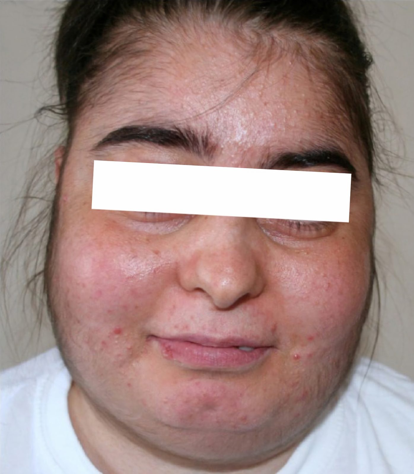 Clinical photograph illustrating central obesity, moon face, dorsocervical fat pad and purple abdominal striae.