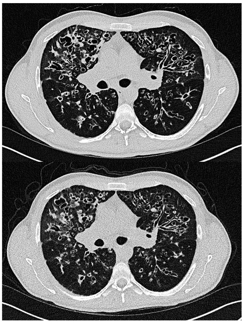 Paired axial high-resolution chest CT images showing bilateral upper-lobe-predominant bronchiectasis, bronchial-wall thickening and mucus plugging in cystic fibrosis.