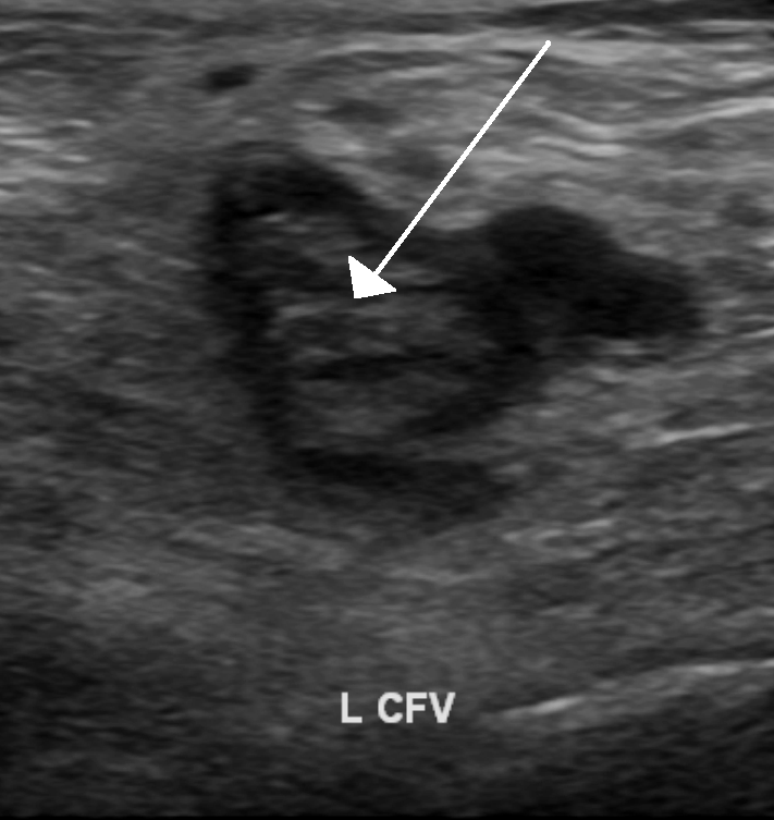 Transverse greyscale ultrasound showing echogenic thrombus within the left common femoral vein, marked by the arrow, confirming proximal deep-vein thrombosis.