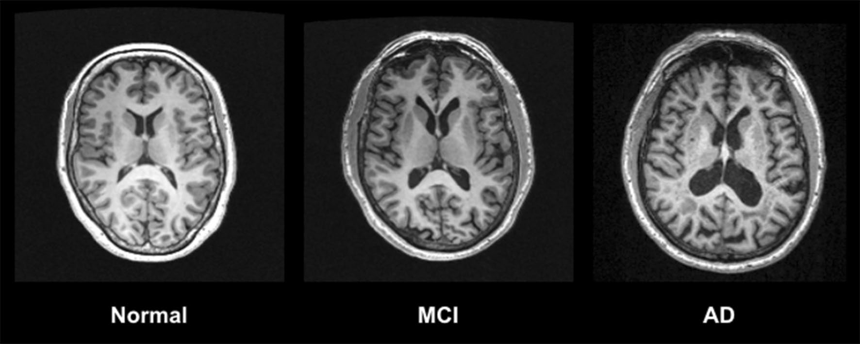Comparative MRI images illustrating that structural patterns may support subtype assessment but cannot diagnose dementia alone.