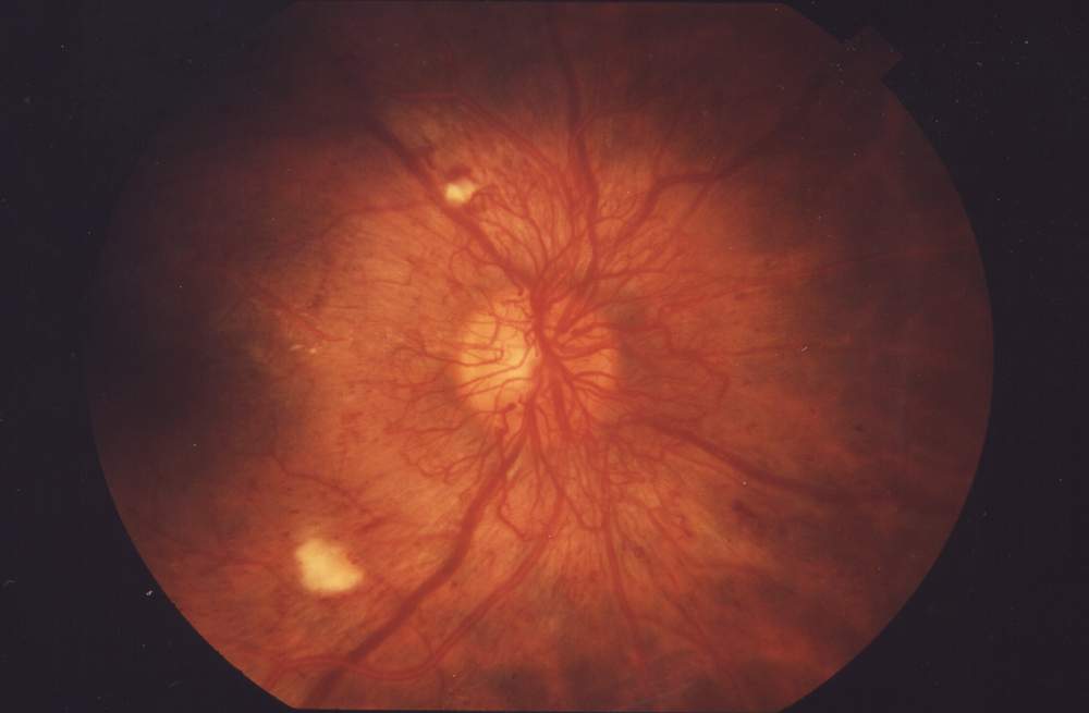 Retinal photograph showing abnormal new vessels at the optic disc with associated haemorrhage.