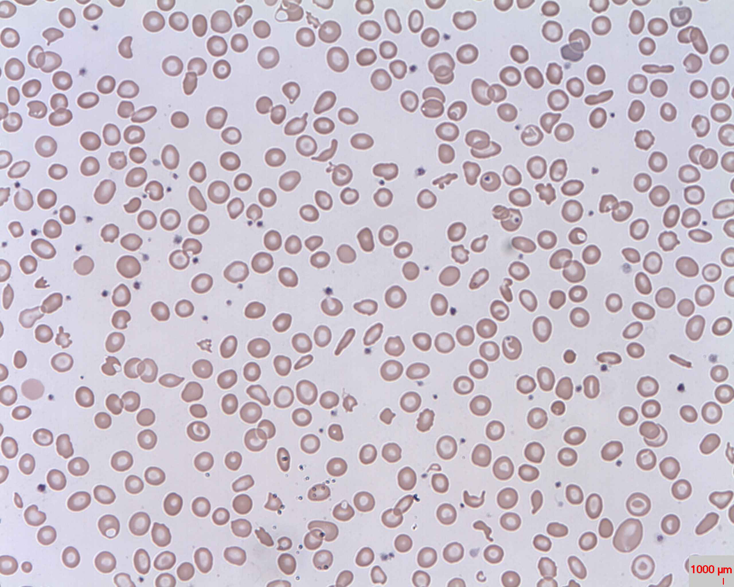 A blood film showing fragmented red cells (schistocytes) and reduced platelets, with a note that schistocytes indicate microangiopathic injury but are not specific for DIC.