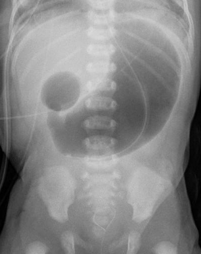 An abdominal radiograph showing the double-bubble sign of duodenal atresia, an important association requiring urgent surgical assessment when bilious vomiting is present.