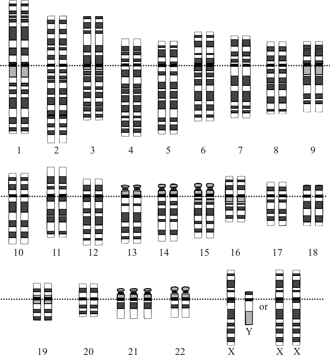 A labelled karyogram showing three copies of chromosome 21, the defining chromosomal finding in Down syndrome.