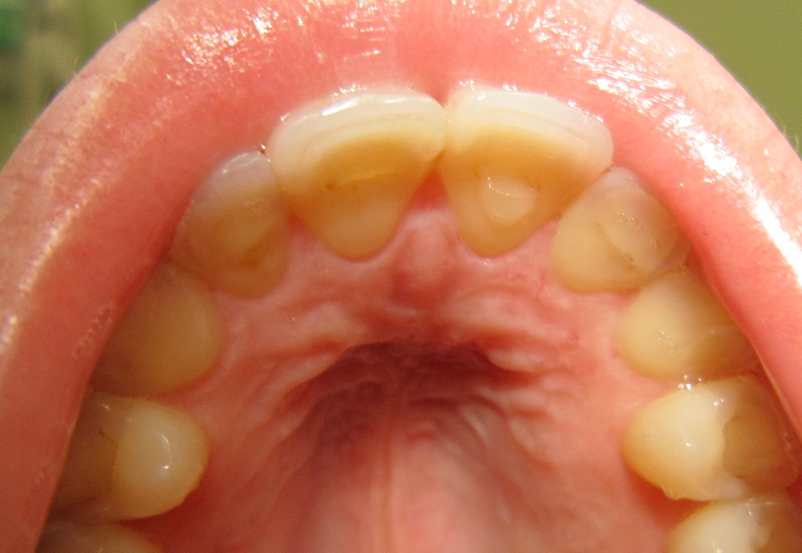 Intraoral photograph showing smooth enamel loss and exposed dentine on palatal tooth surfaces after repeated gastric-acid exposure; a clinical clue to vomiting, not a diagnostic requirement.