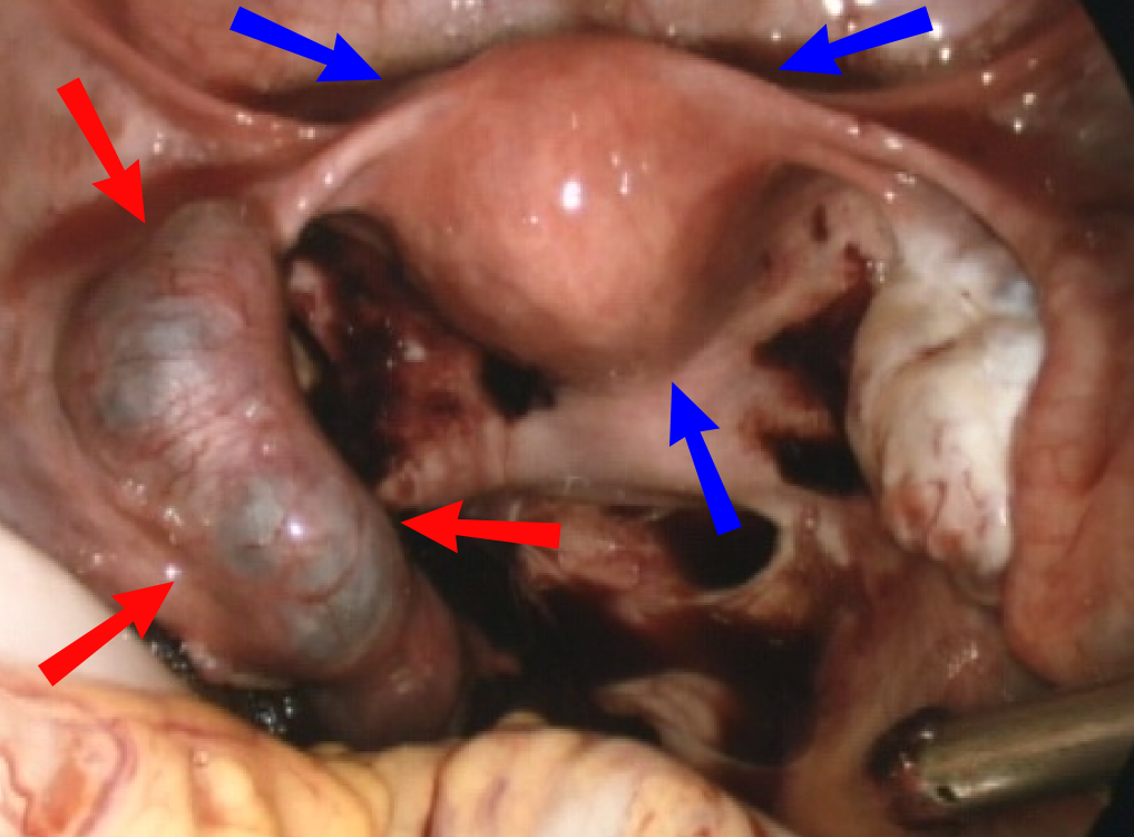 Laparoscopic view of a tubal ectopic pregnancy distending the fallopian tube.