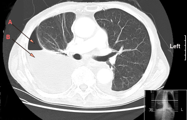Axial chest CT showing a large right pleural air-fluid collection with pleural thickening and compression of adjacent lung, consistent with empyema and hydropneumothorax.