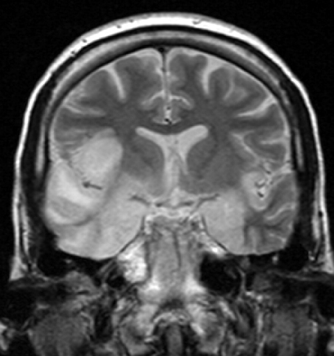 An MRI showing swelling and signal change in the mesial temporal lobe, the characteristic distribution of herpes simplex encephalitis.