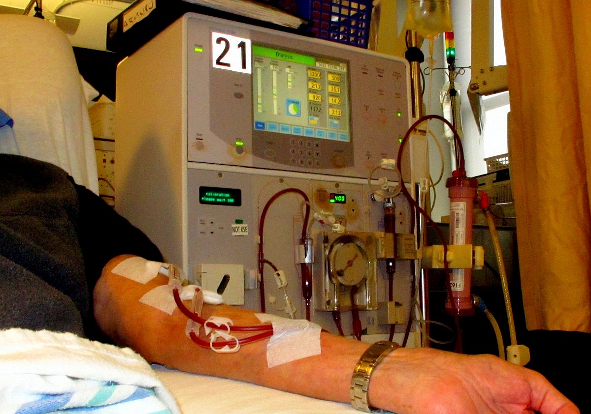 A forearm arteriovenous fistula connected to a haemodialysis circuit, with the image labelled as planned vascular access rather than a substitute for access assessment.