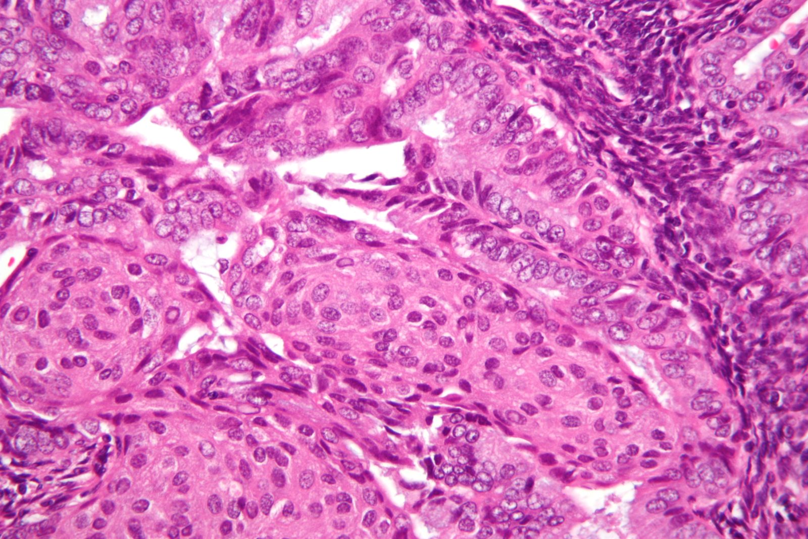High-magnification H&E micrograph showing crowded malignant glands lined by atypical cells in endometrioid endometrial adenocarcinoma.