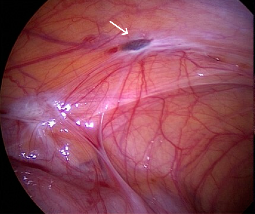 Laparoscopic view showing an arrowed blue-black superficial endometriotic implant on the pelvic peritoneum with adjacent fibrous adhesions.