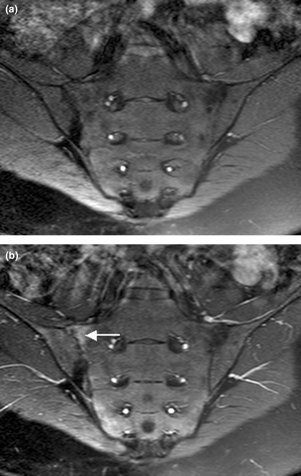 Semicoronal sacroiliac-joint MRI showing inflammatory marrow signal adjacent to the sacroiliac joint, illustrating axial spondyloarthritis that can accompany inflammatory bowel disease.