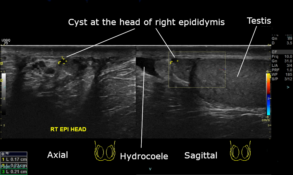 Annotated axial and sagittal scrotal ultrasound showing a small cyst at the head of the right epididymis adjacent to a normal testis, with a small hydrocoele also visible.