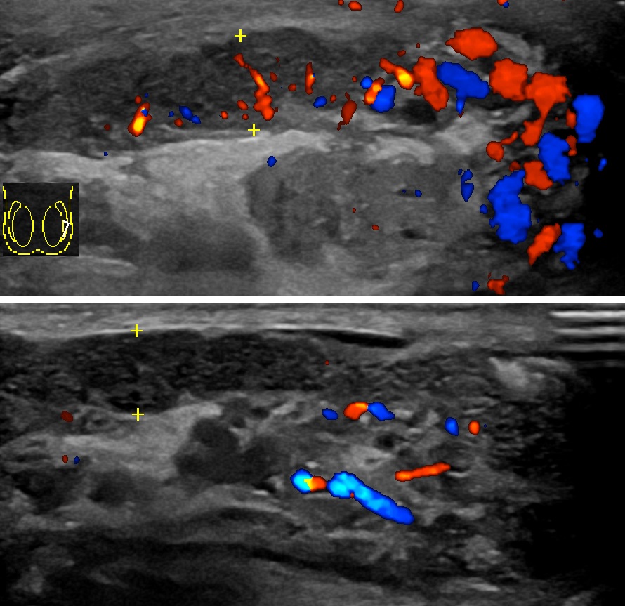 A colour Doppler ultrasound of the scrotum showing enlargement and increased vascularity of the epididymis in acute epididymitis.
