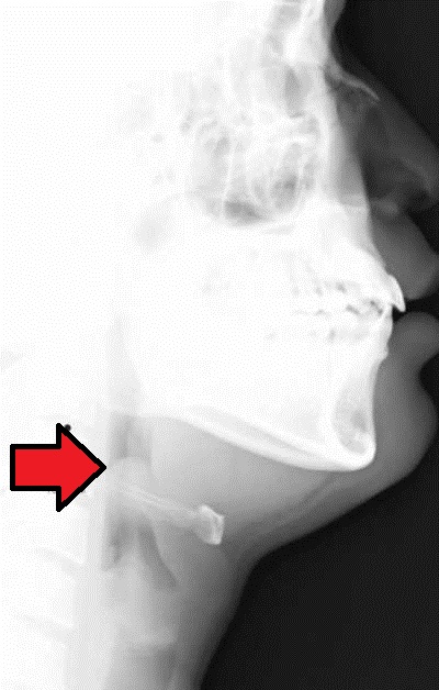 A lateral soft-tissue neck radiograph showing a swollen epiglottis producing the thumbprint sign, contrasted with the normal narrow epiglottic shadow.