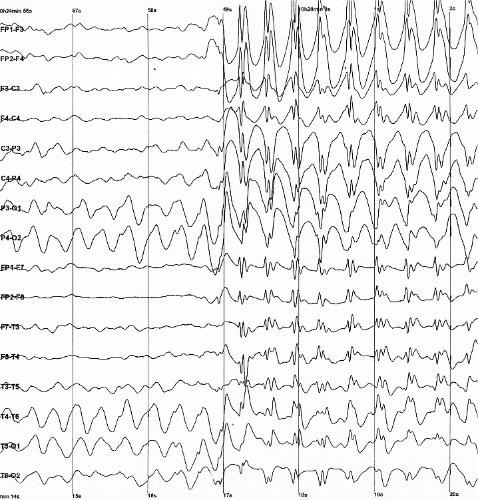 EEG trace showing interictal epileptiform spike-and-wave discharges compared with normal background rhythm.