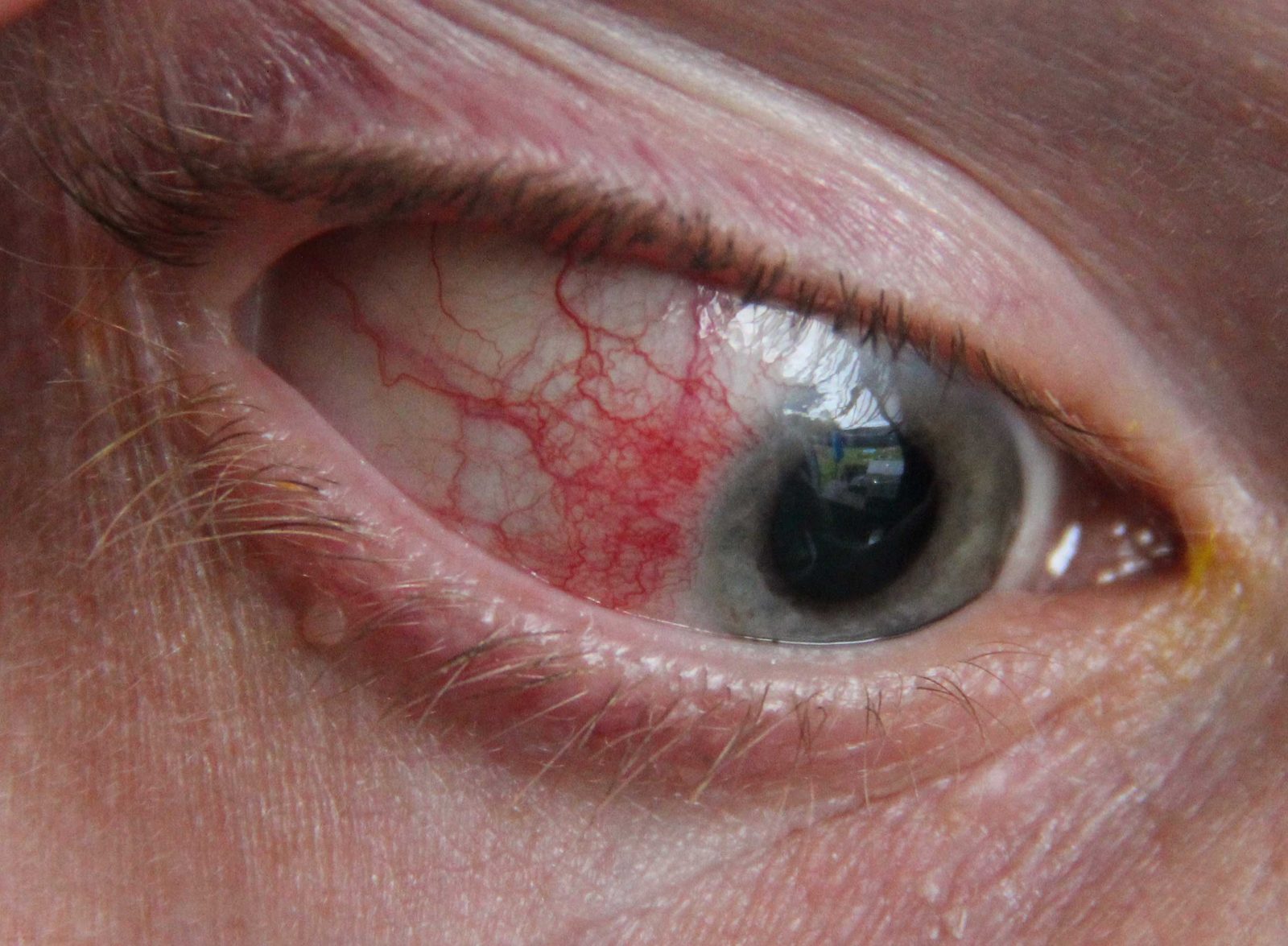 Clinical photograph of localised superficial redness on the white of the eye with an otherwise clear cornea; label it as an illustrative image and include a reminder to check vision, pain severity and the anterior chamber.