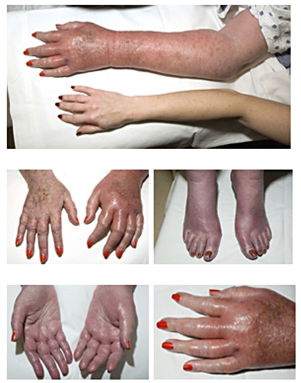 A clinical photograph of erythromelalgia showing red, warm, painful extremities from platelet-mediated microvascular occlusion.