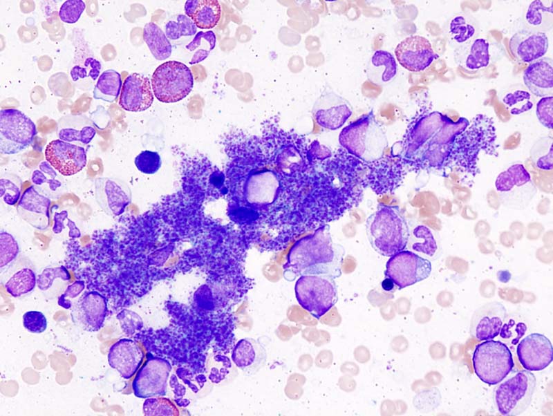 A blood film showing markedly increased platelets, including large forms, with otherwise unremarkable red and white cells, typical of essential thrombocythaemia.