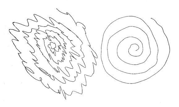 Paired Archimedes spirals drawn with each hand, showing marked waviness from an action tremor. Use it to demonstrate an examination task, not as a standalone diagnostic test.
