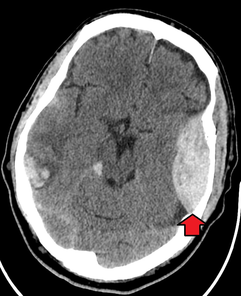 Non-contrast CT showing a biconvex, lentiform extra-axial collection adjacent to a temporal skull fracture.