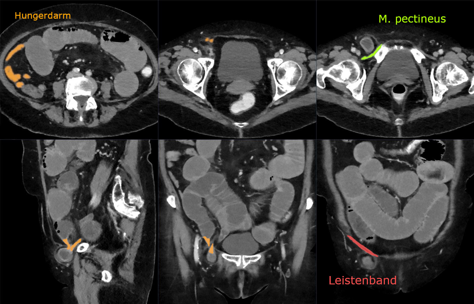 Annotated multiplanar CT showing a right femoral hernia sac below the inguinal ligament, with associated small-bowel dilatation from incarceration and obstruction.