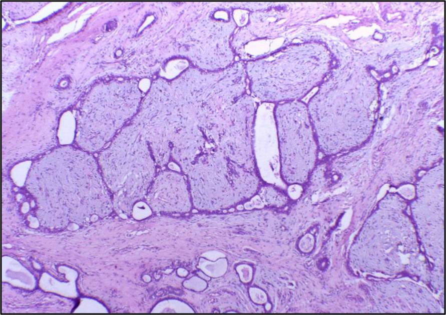Histology showing benign biphasic fibroepithelial architecture, with proliferating stroma around epithelial-lined ducts.