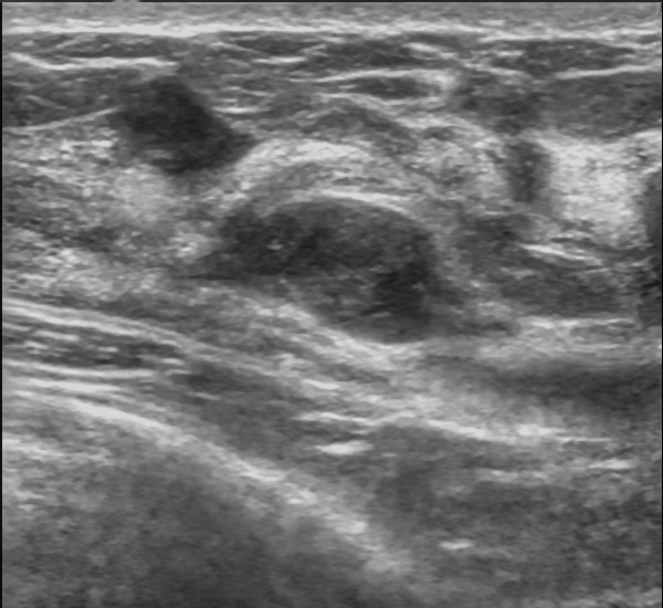 Breast ultrasound showing a well-defined oval mass with smooth margins, labelled as a benign-appearing feature that still requires clinical and imaging concordance.