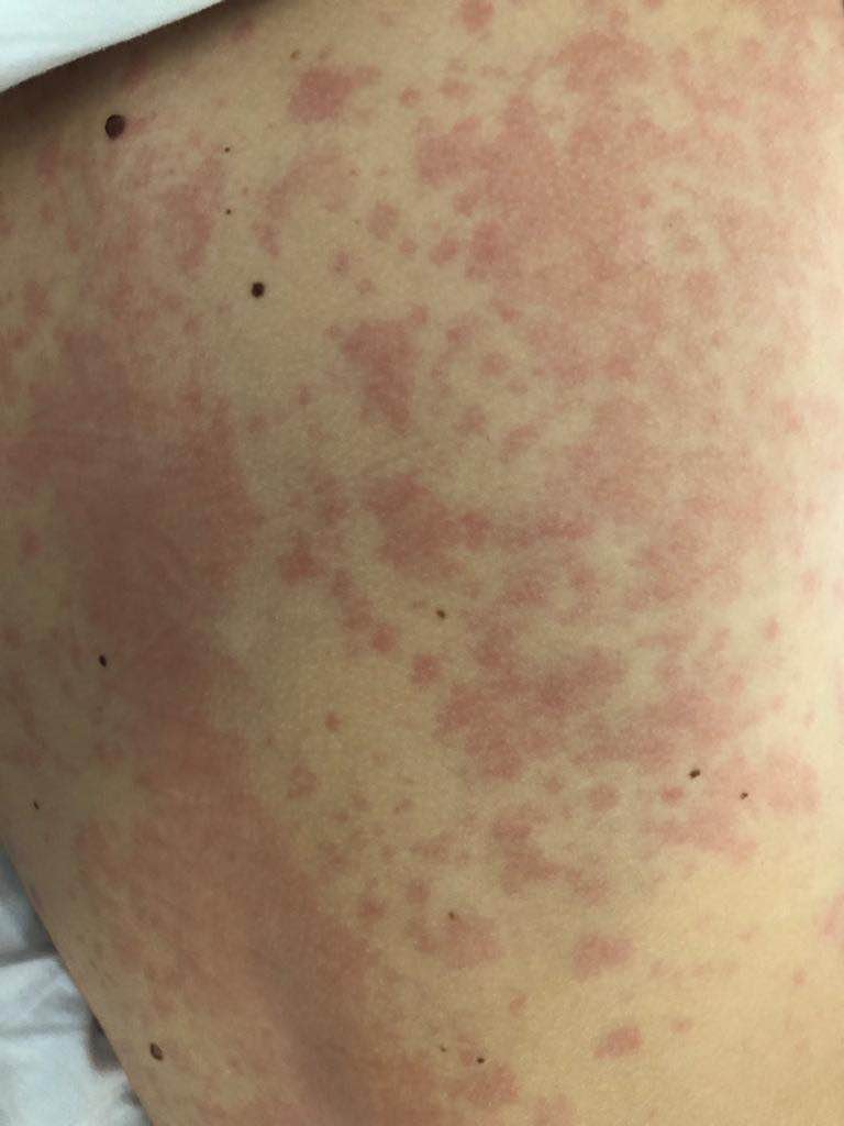 Confluent blanching erythematous wheals showing a typical immediate skin feature of IgE-mediated allergy, with a reminder that the presence or absence of rash does not define anaphylaxis.