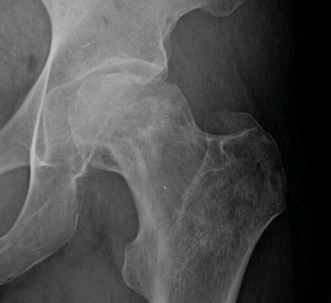 A radiograph or MRI of femoral-head osteonecrosis showing sclerosis and collapse of a fragment with a precarious blood supply.
