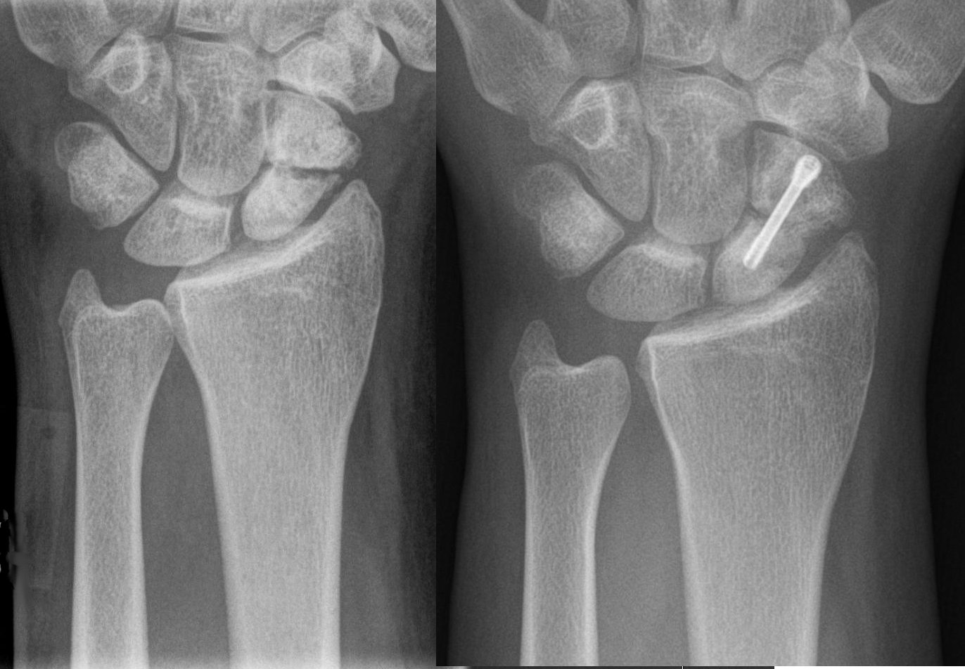 Paired wrist radiographs showing a persistent scaphoid non-union and the subsequent appearance after internal fixation with a Herbert screw.