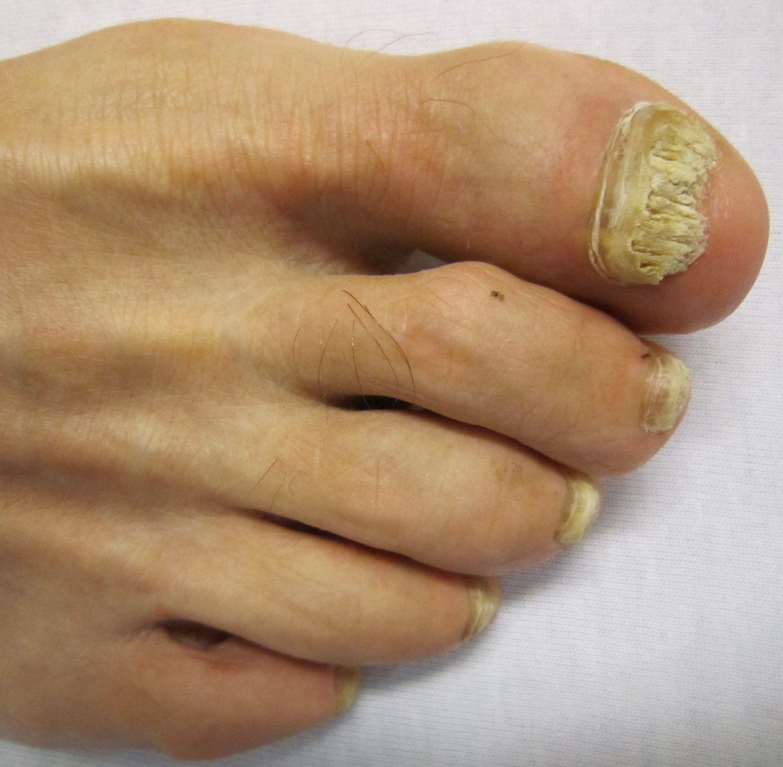 Clinical photograph of a thickened, discoloured, crumbling toenail typical of fungal nail infection.