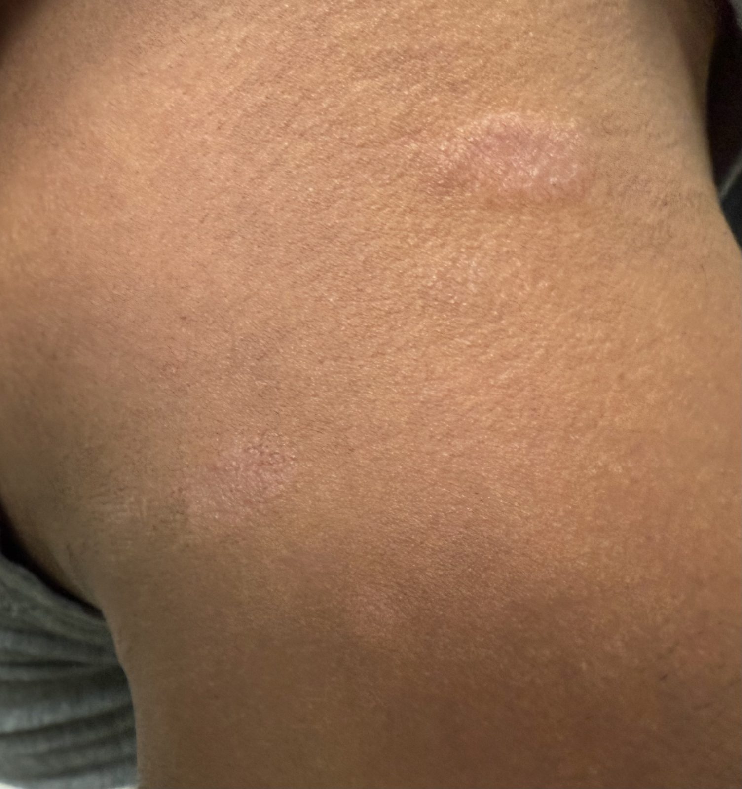 Clinical photograph of an annular scaly plaque with an active raised edge and central clearing on the trunk.