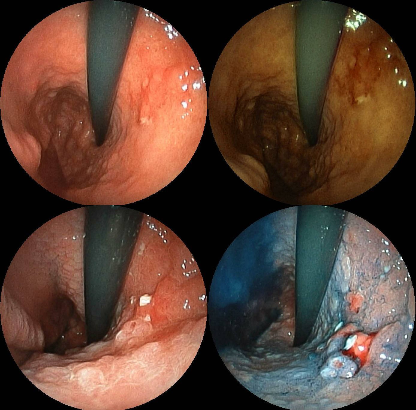OGD image showing an ulcerating gastric mass with irregular, raised margins.