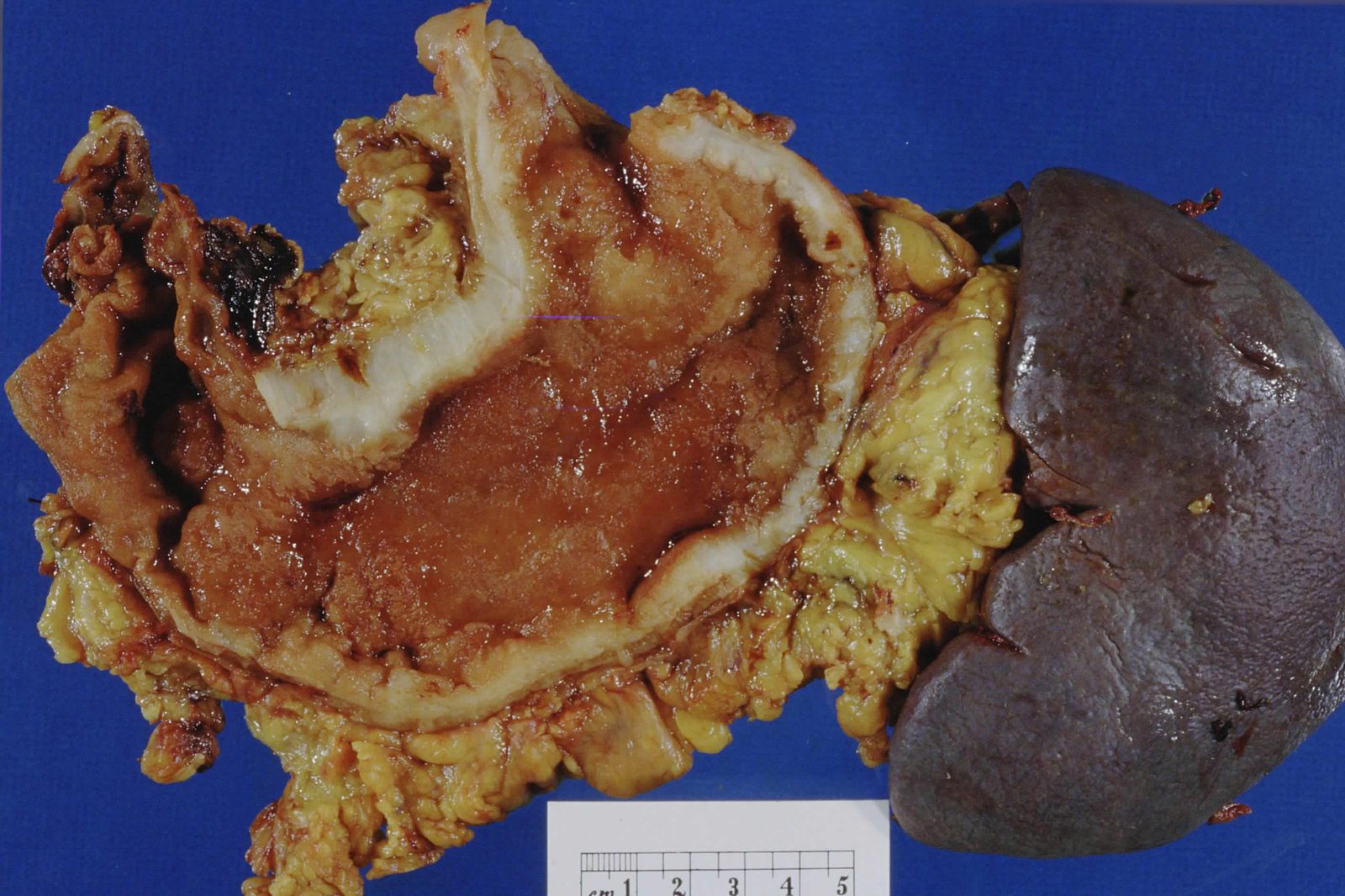 Resected stomach showing a thickened, tumour-infiltrated gastric wall.