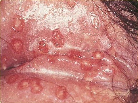 Clinical photograph of grouped vesicles, pustules and shallow erosions on vulval mucosa in genital herpes infection.