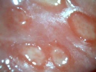 Clustered vesicles and shallow ulcers of genital herpes simplex infection.