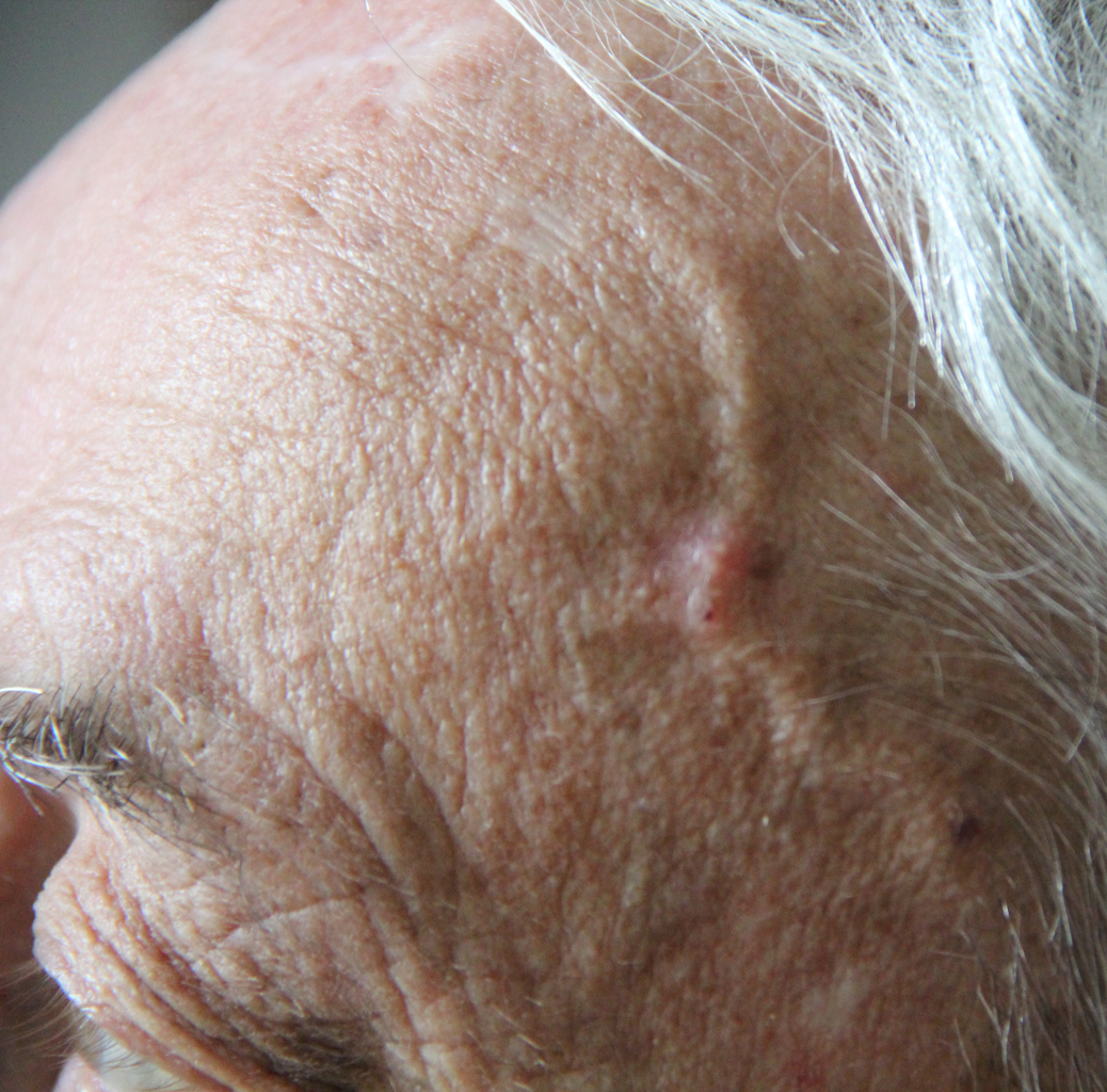 Clinical photograph demonstrating a thickened, tender or nodular temporal artery, with a note that examination can be normal despite GCA.