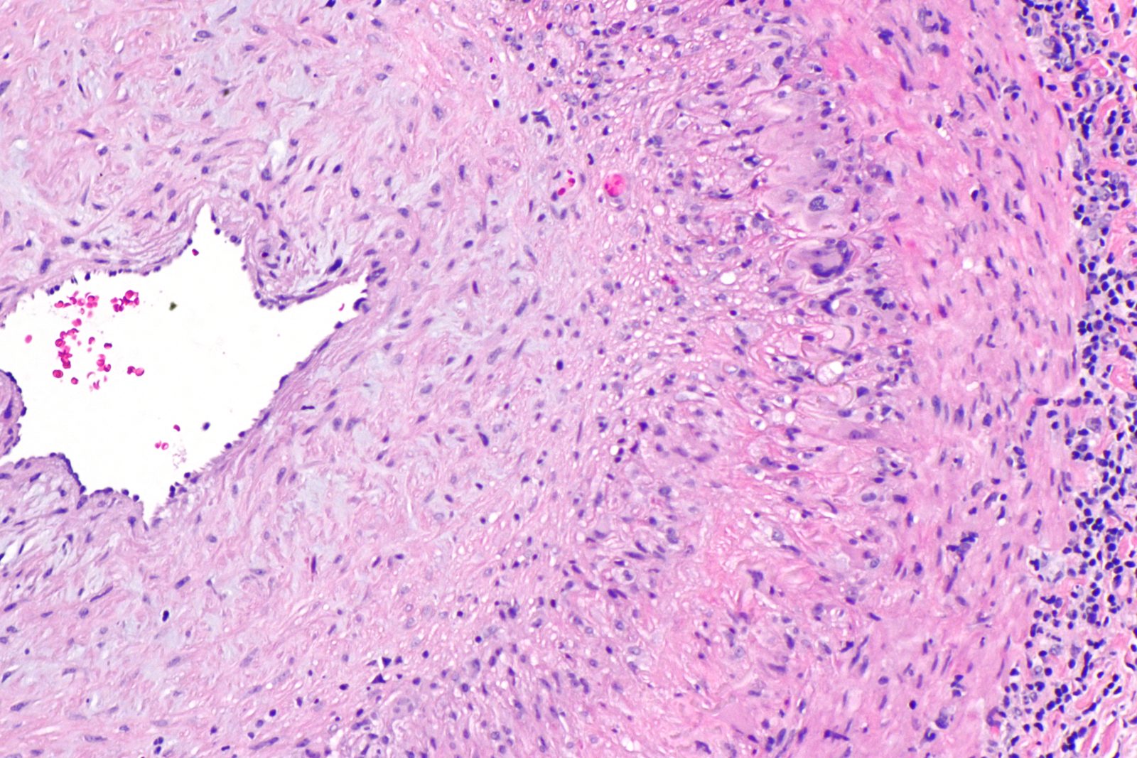 Histology of a temporal artery showing granulomatous inflammation and disruption of the internal elastic lamina, with a reminder about skip lesions.