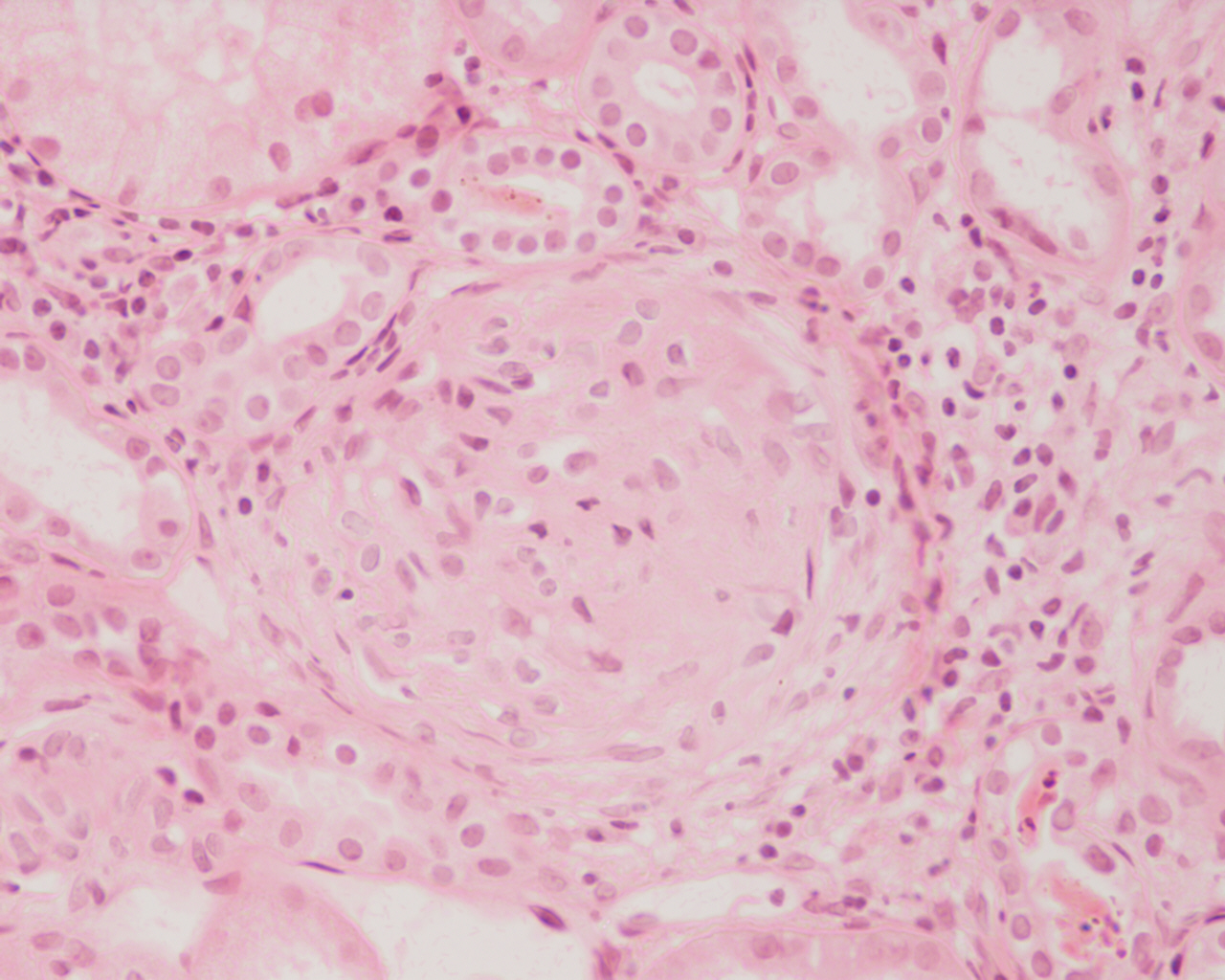 Histology image showing cellular crescent formation within Bowman's space compressing the glomerular tuft.
