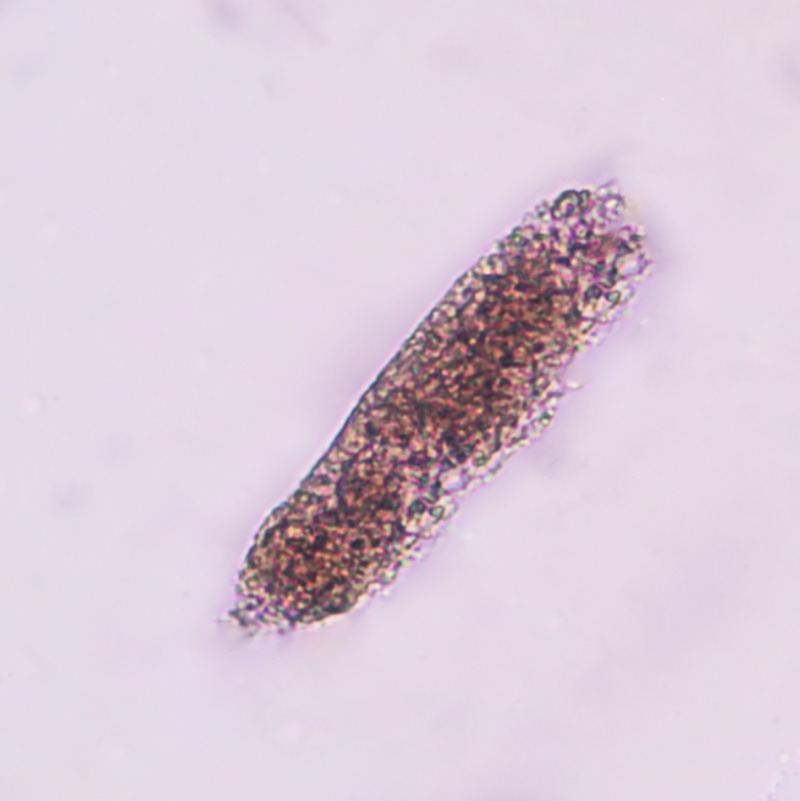 Microscopy image showing dysmorphic red blood cells and a red cell cast, indicating glomerular bleeding.